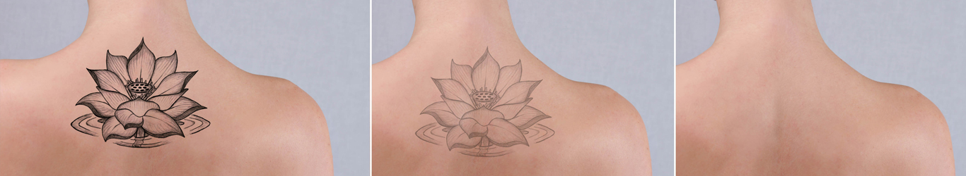 Permanent Tattoo Removal Treatment by Eudermiz Clinic in Hyderabad